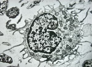 F,43y. | blood - hairy cell leukemia